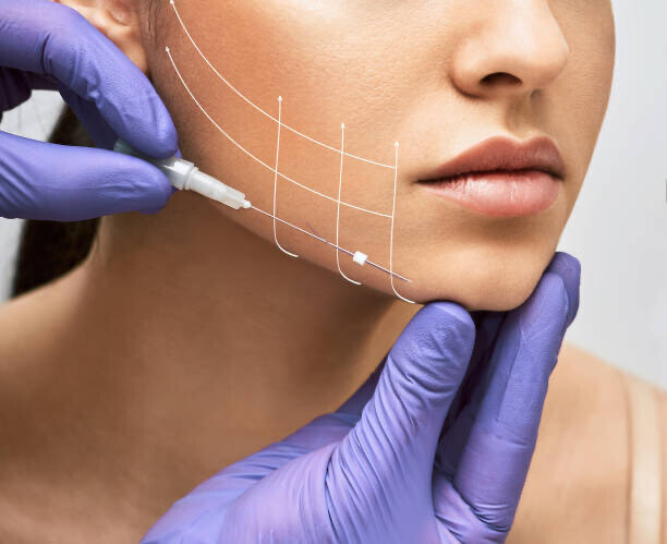 PDO cog cheek and jaw lift