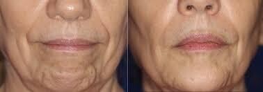 Anti wrinkle chin dimples