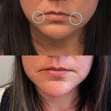 Anti wrinkle down turned smile