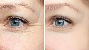 Crows feet
