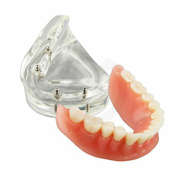 MODELO DEMOSTRACIÓN M6003 CON 4 IMPLANTES