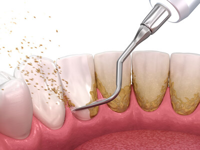 Periodontics