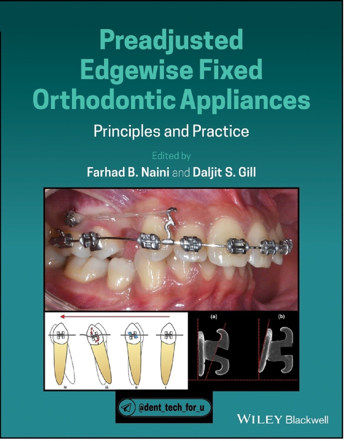 Preadjusted Edgewise Fixed Orthodontic Appliances