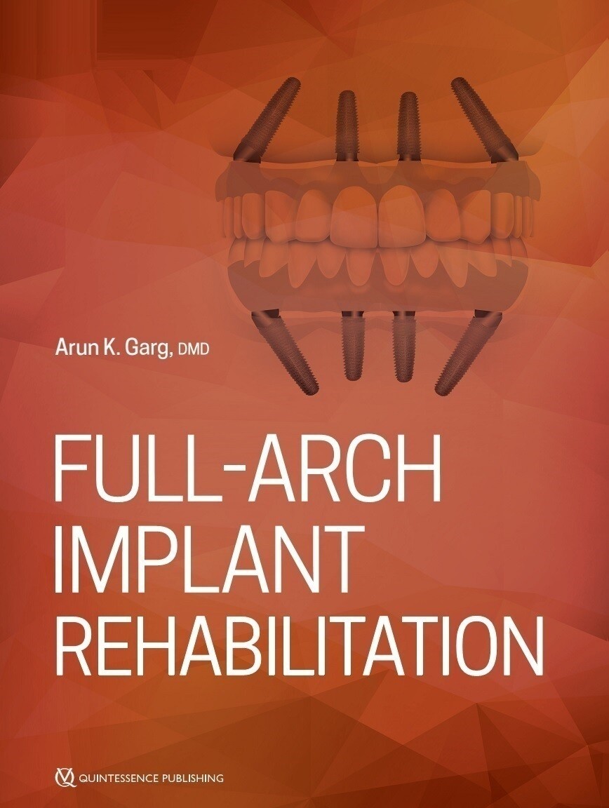 Full-Arch Implant Rehabilitation