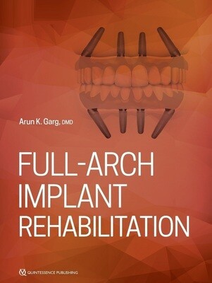 Full-Arch Implant Rehabilitation