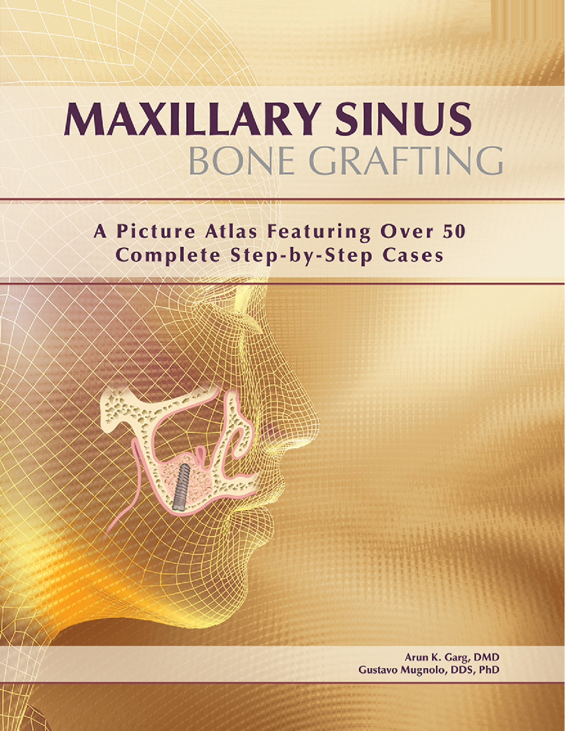 Maxillary Sinus Bone Grafting
