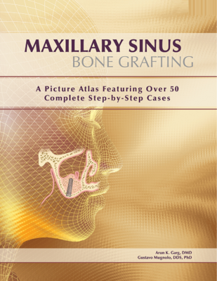 Maxillary Sinus Bone Grafting