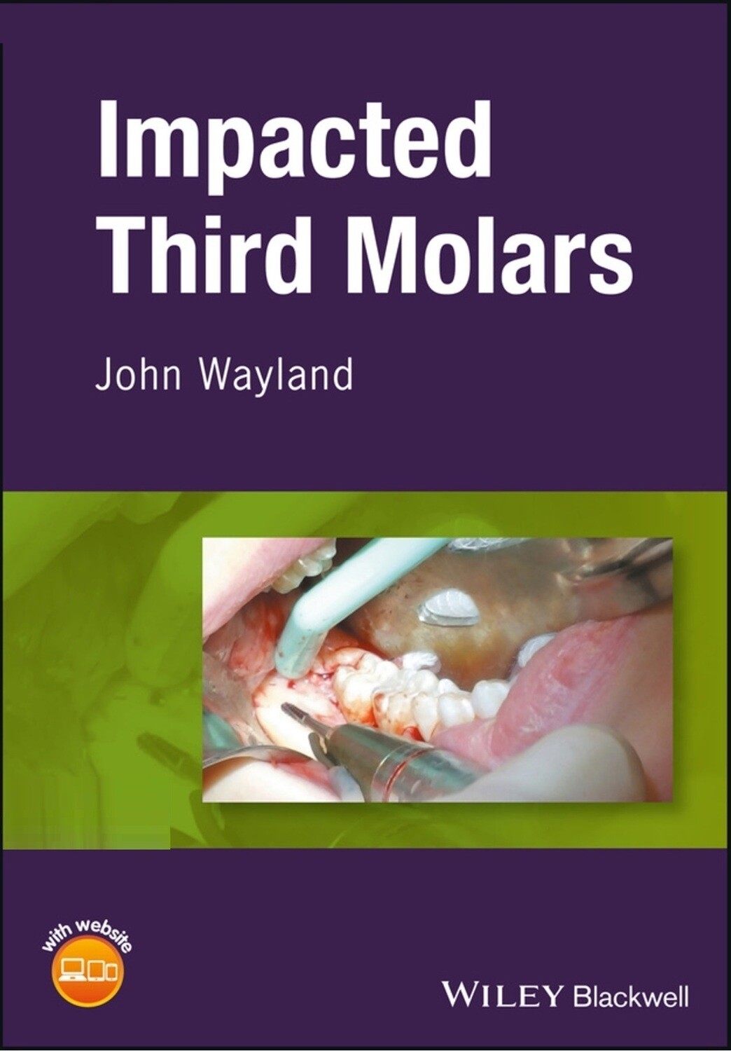Impacted third molar