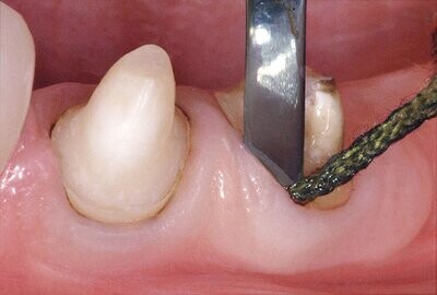 Retraction Cord Packer