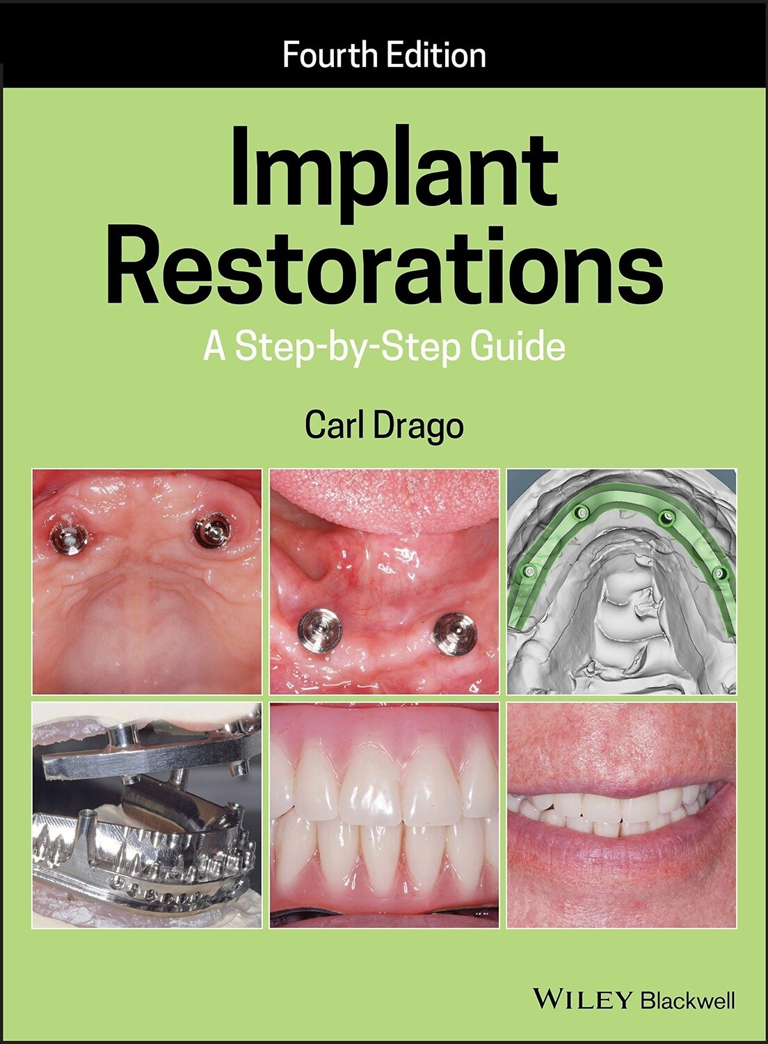 Implant Restorations step by step guide