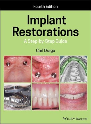 Implant Restorations step by step guide