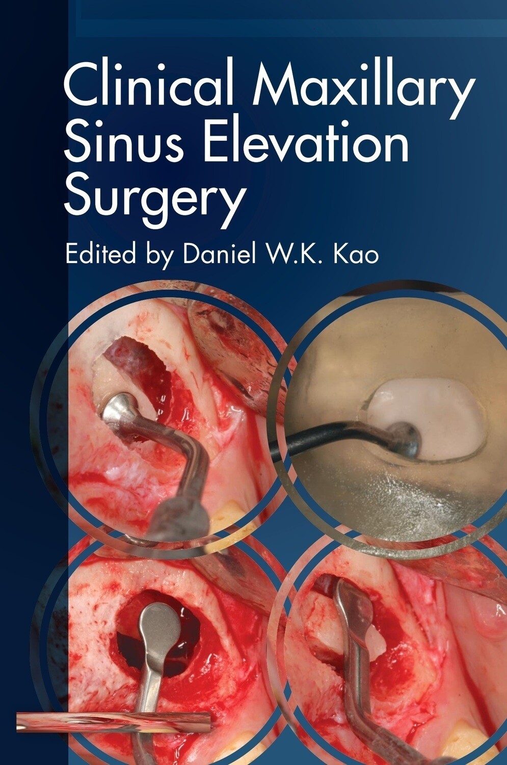 Clinical Maxillary Sinus Elevation Surgery