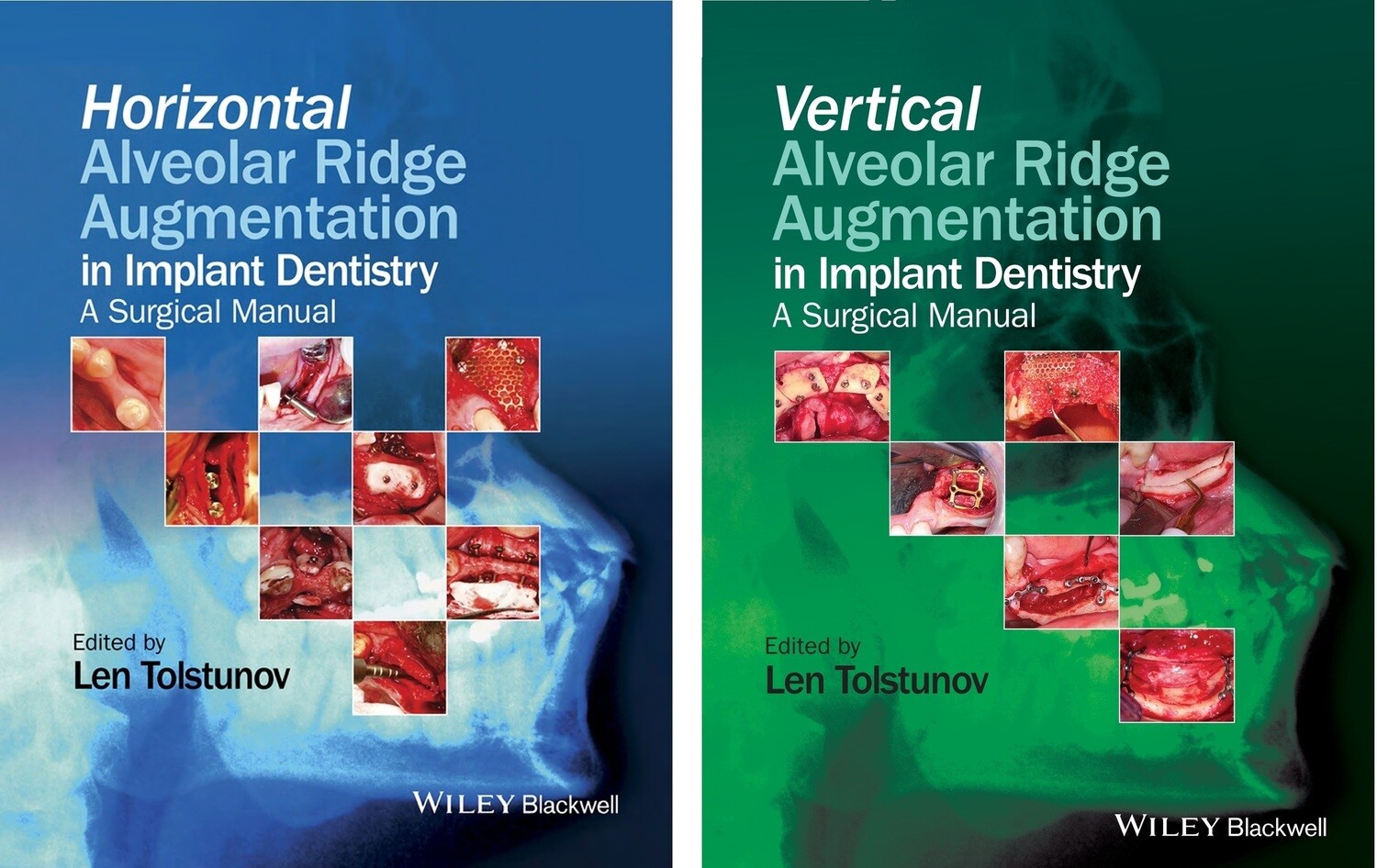 Vertical &amp; Horizontal alveolar bone augmentation in implant dentistry