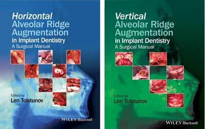 Vertical &amp; Horizontal alveolar bone augmentation in implant dentistry