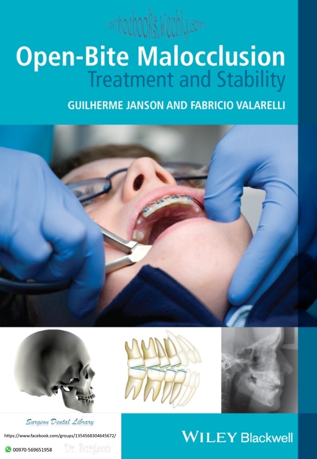 Open-bite malocclusion