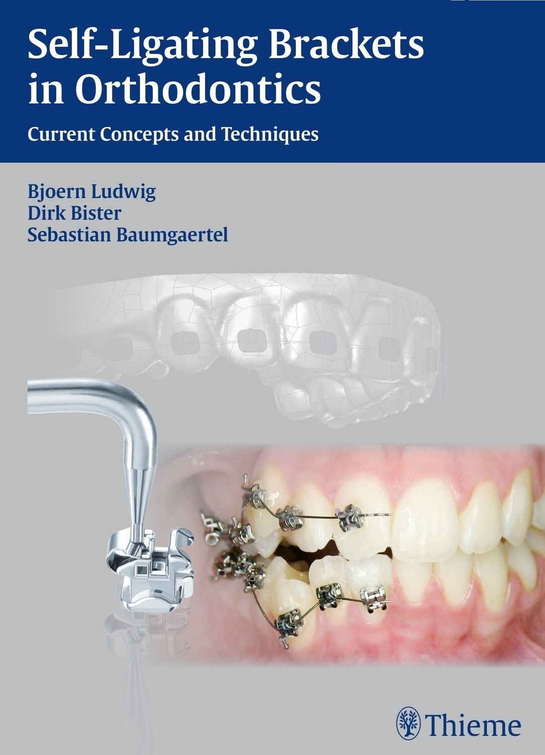 Self-ligating brackets in orthodontics