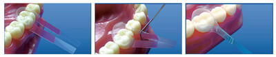 Self-Adhesive Transparent Contoured Matrix