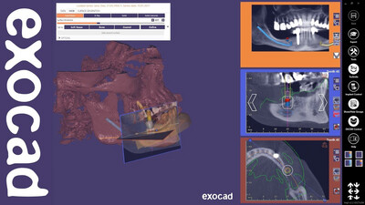 Exocad &amp; Exoplan