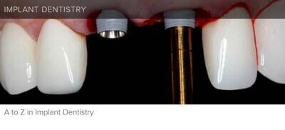 A to Z in Implant Dentistry