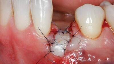 Dental Soft Tissue Management around Natural Teeth and Dental Implants