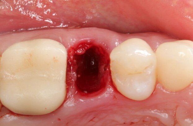 Dental Extraction Socket