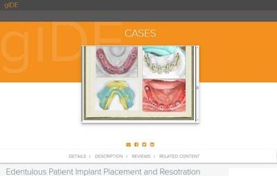 Edentulous Patient Implant Placement and Restoration