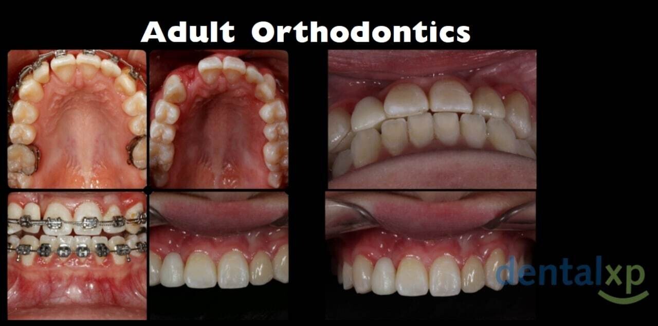 Adult Orthodontics