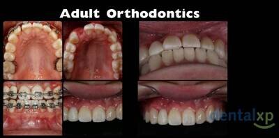 Adult Orthodontics