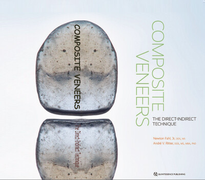 Composite Veneers The Direct-Indirect Technique