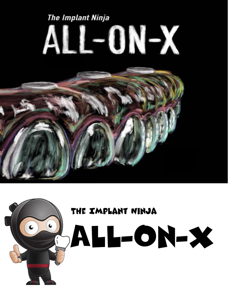 Implant Ninja The All on X