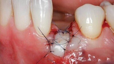Periodontal Courses