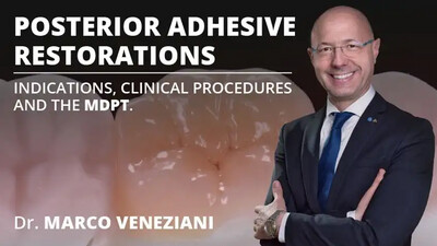 Posterior Adhesive Restorations