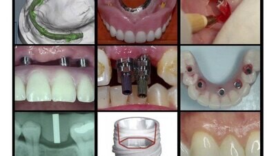 A-Z in Restorative Implant Dentistry