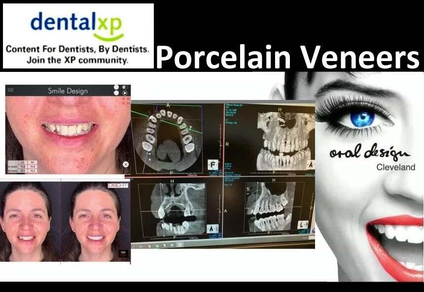 Porcelain Veneers