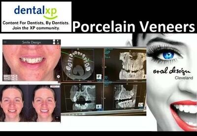 Porcelain Veneers