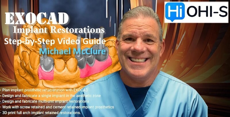 EXOCAD Implant Restorations, Step-by-Step Video Guide
