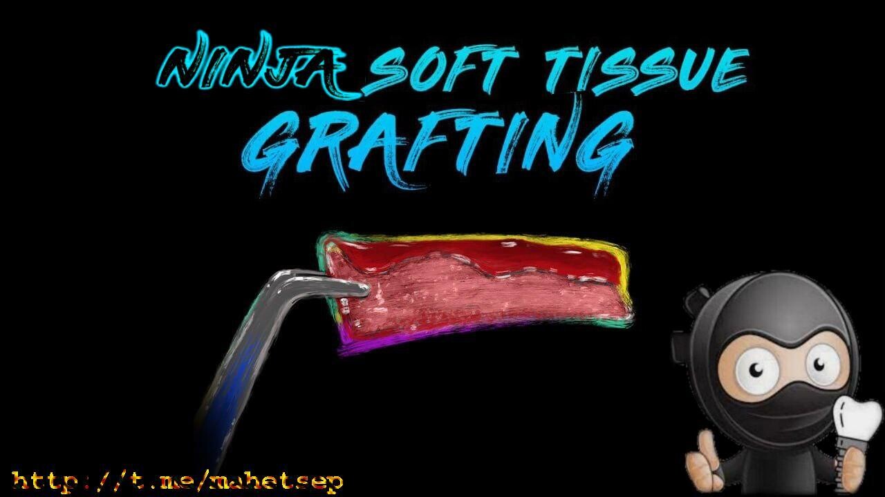 Ninja Soft Tissue Grafting
