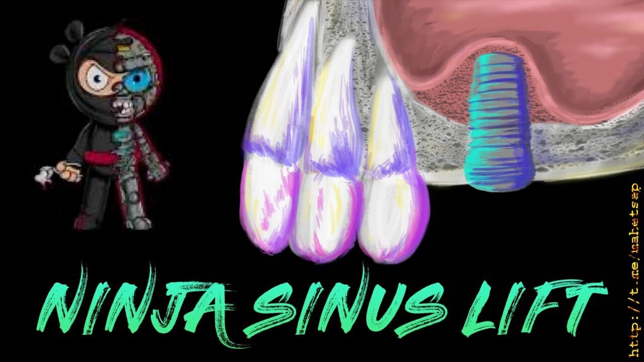 Ninja Sinus Lift
