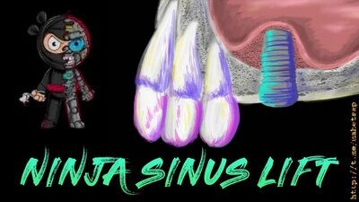 Ninja Sinus Lift