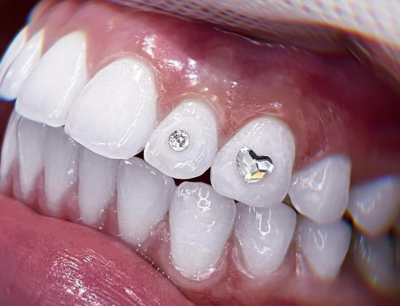 Tooth Crystal
