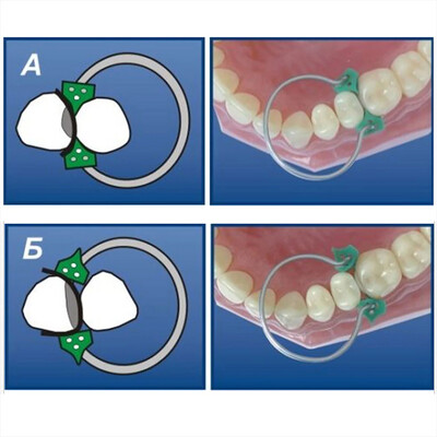 Add-on silicone wedge