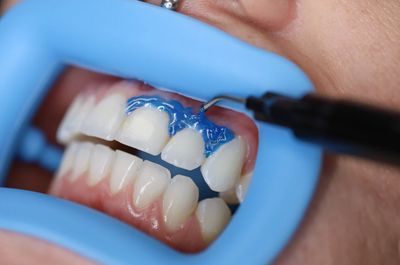 Gingival Barrier Gel