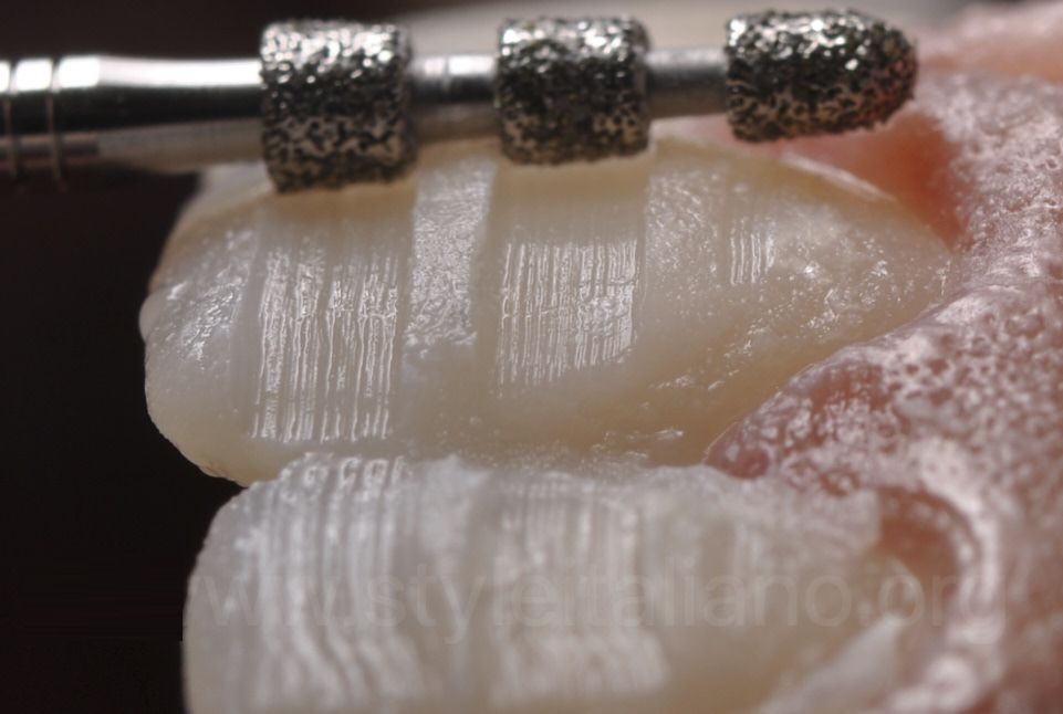 Veneer Preparation Burs