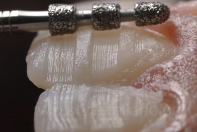 Veneer Preparation Burs