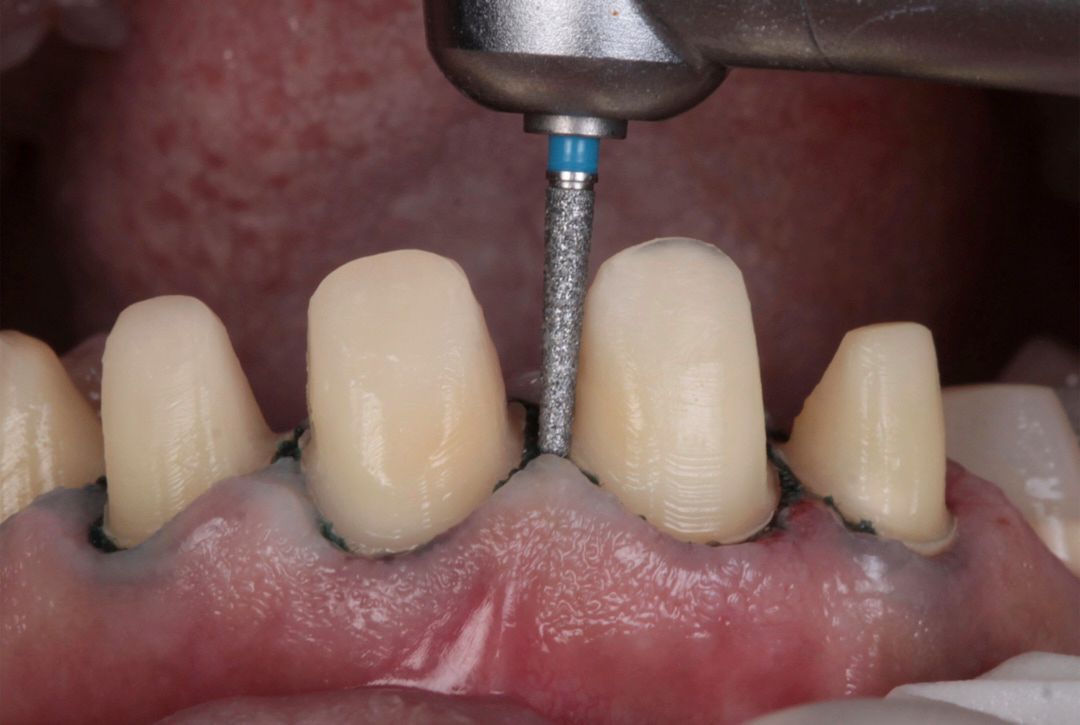 Tooth Preparation Kit