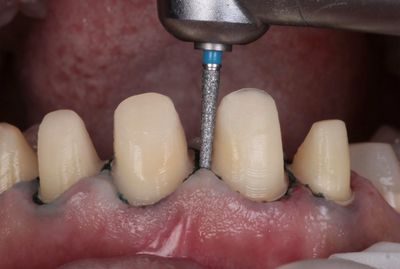 Tooth Preparation Kit
