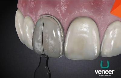 U-Veneer