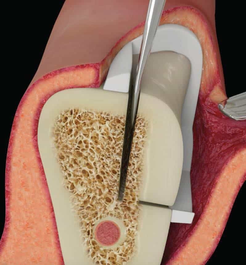 Autogenous Bone Collector