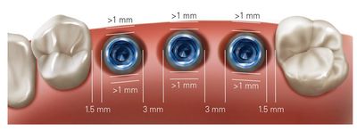 M-D Positioning Guide