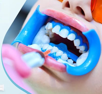 In-office Whitening Material